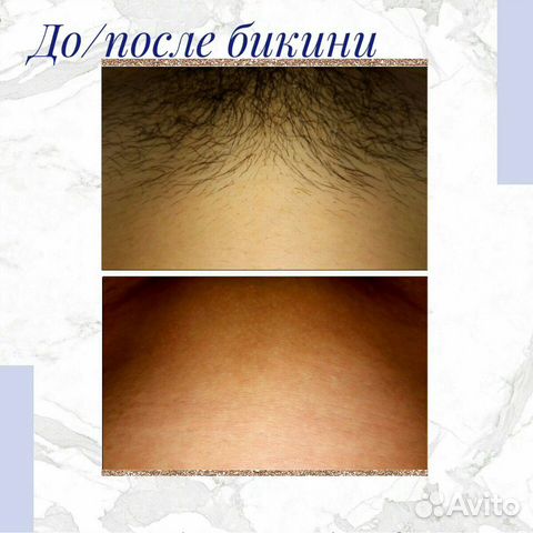 Депиляция воском