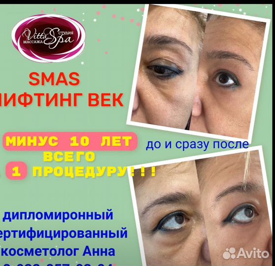 Безоперационная блефаропластика век