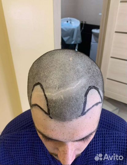 Пересадка волос без швов, рубцов и шрамов