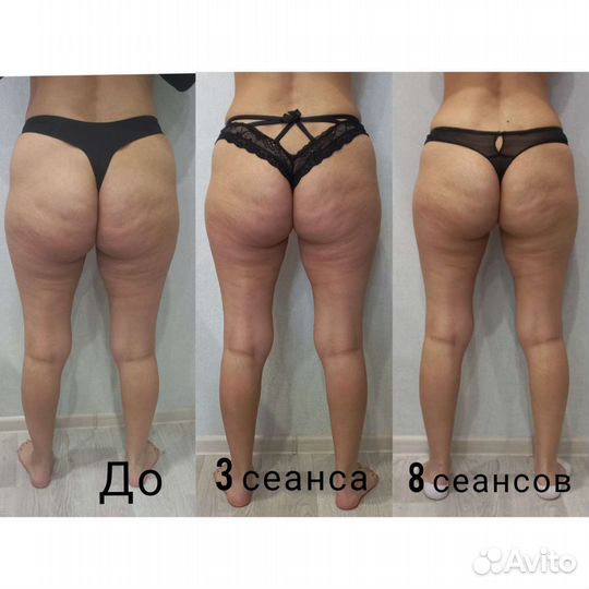 Антицеллюлитный ручной массаж, RFлифтинг,кавитация