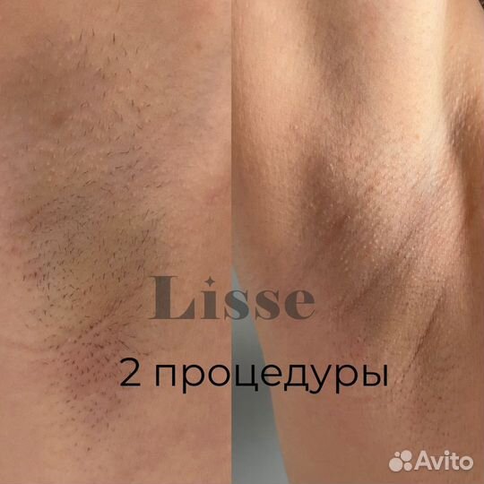 Лазерная эпиляция в Казани в сети студий Lisse