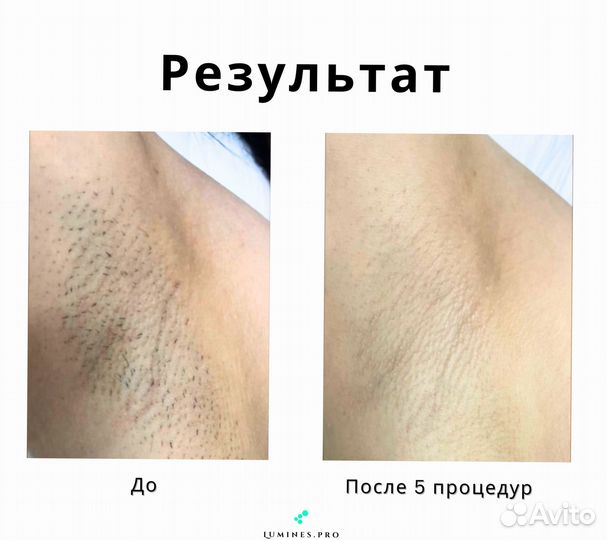 Диодный лазер Lumines Макс Ван 1200в