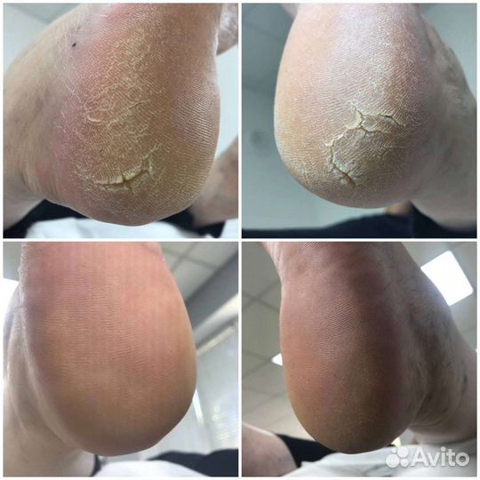 Подолог Выезд на дом Парамедицинский педикюр