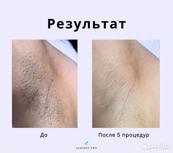 Аппарат для эпиляции «Lumines» Макс’Ван 1200W