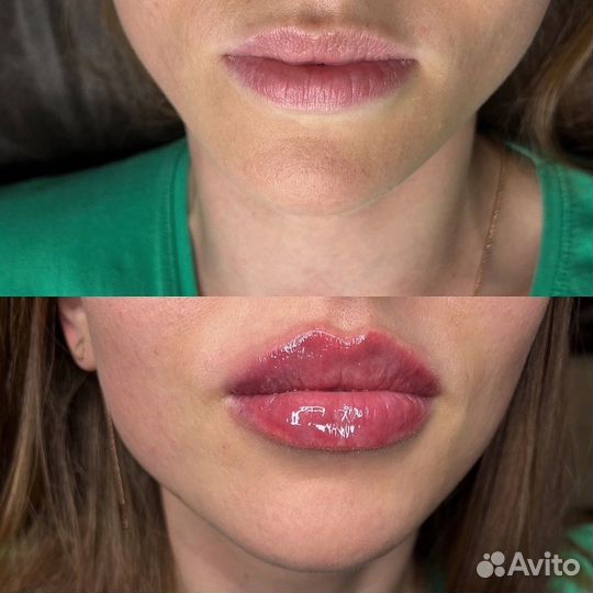 Модель на увеличение губ