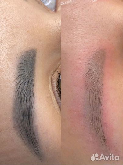 Удаление татуажа