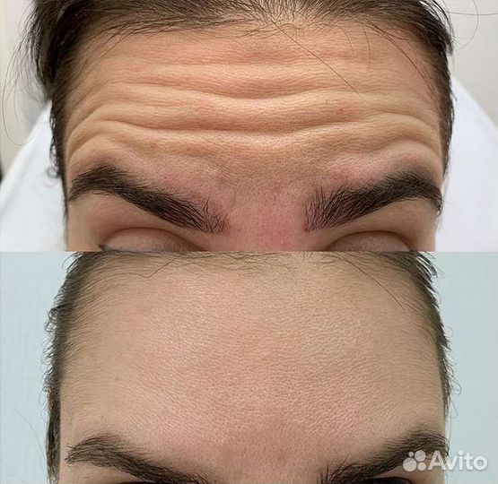 Ботокс для лица