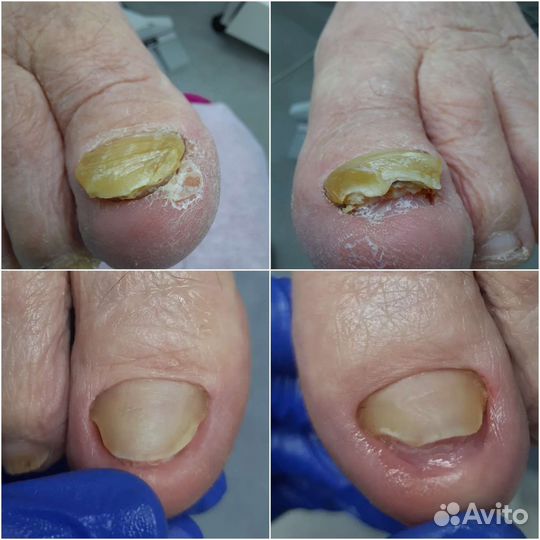 Подолог.Медицинский педикюр. Выезд на дом