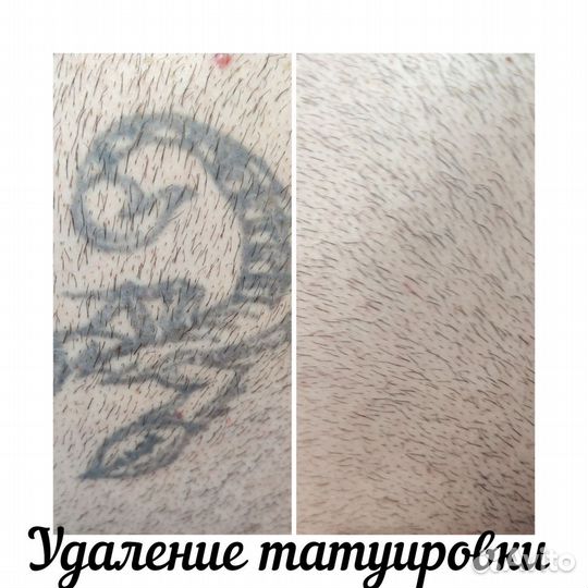 Удаление татуировок