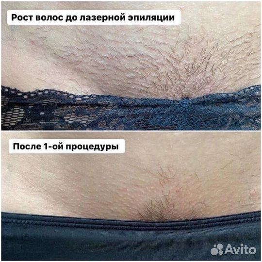 Лазерная эпиляция 7-ми зон по цене 2-х