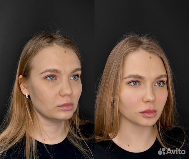 Контурная пластика лица.Full Face.Профиль Джоли