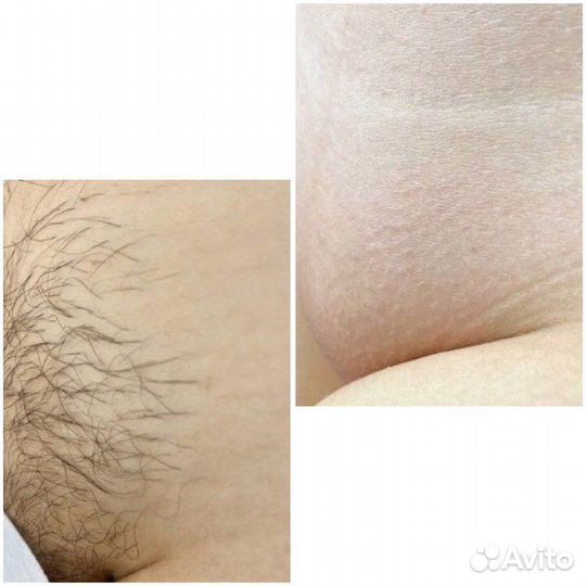 Шугаринг: глубокое бикини