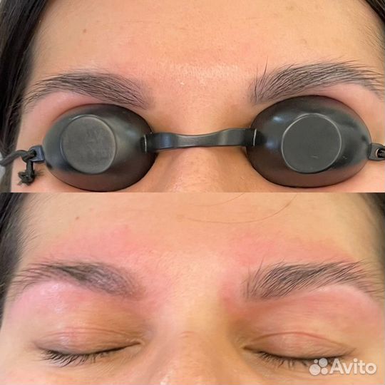 Удаление татуажа, татуировок,перманентного макияжа