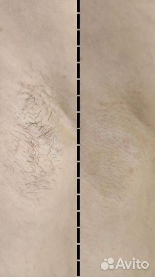 Восковая депиляция