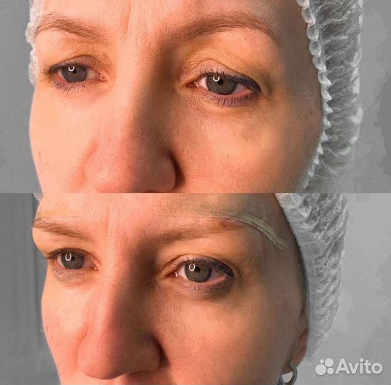 Блеферопластика