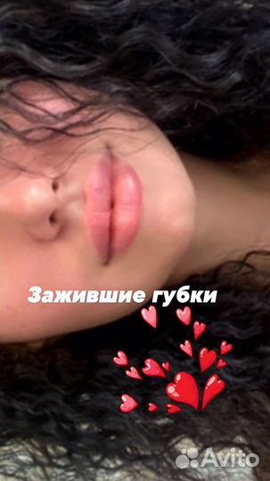 Контурная пластика губ