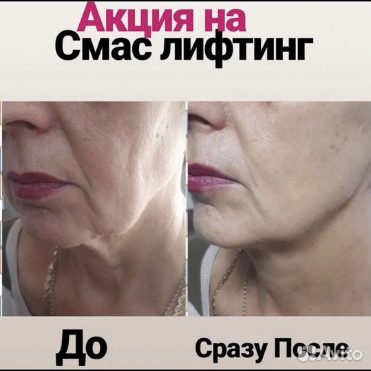 Смас лифтинг
