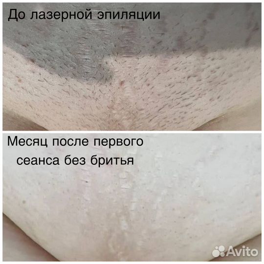 Лазерная эпиляция