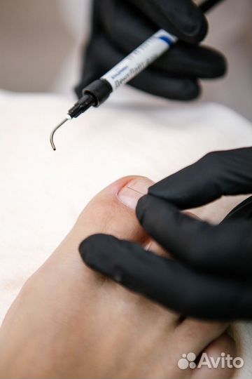 Подолог Педикюр Вросший ноготь Онихолизис