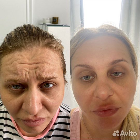 Косметолог. Увеличение губ. Обучение косметологии