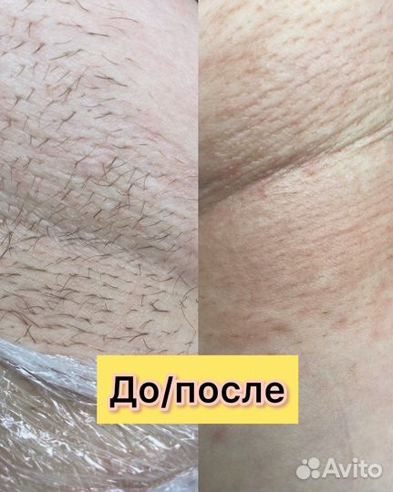 Электроэпиляция