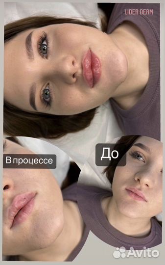 Увеличение губ