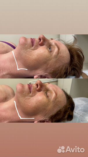 Омолаживающий массаж лица