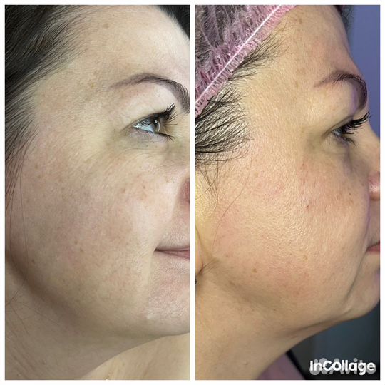 Аппаратный массаж лица