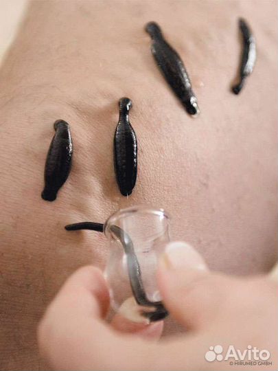 Пиявки медицинские