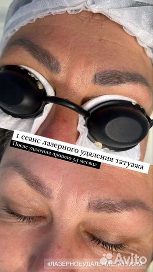 Лазерная эпиляция