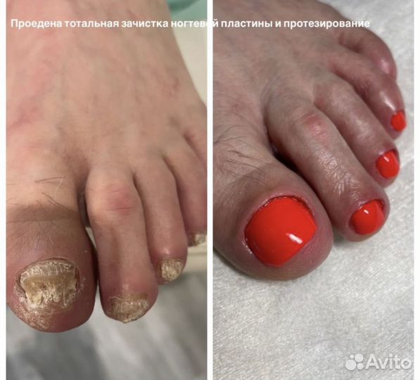 Медицинский педикюр,подолог
