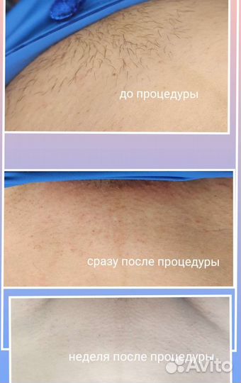 Электроэпиляция модель