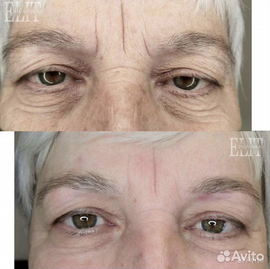 Омоложение холодной плазмой Ангарск