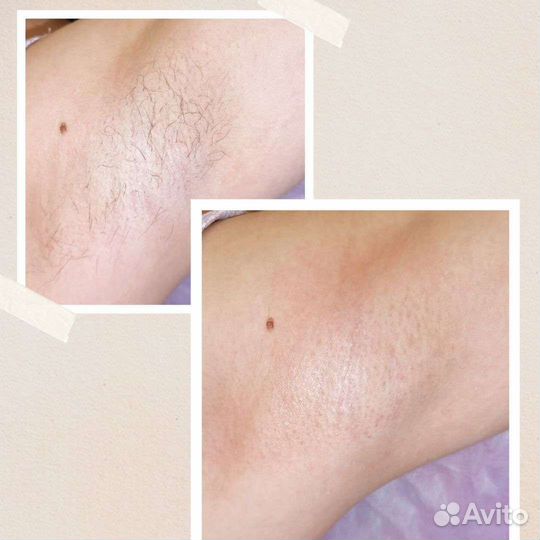 Депиляция Шугаринг