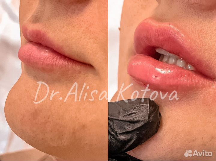 Косметология увеличение губ мезонити