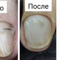 Подолог Грибок, титановая нить, выезд на дом, Йошкар-Ола