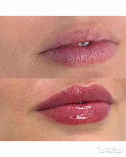 Контурная пластика губ,увеличение губ