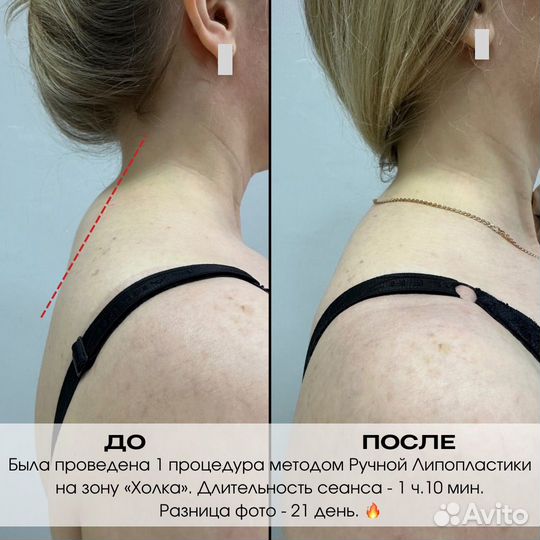 Массаж LPG / Vela Shape