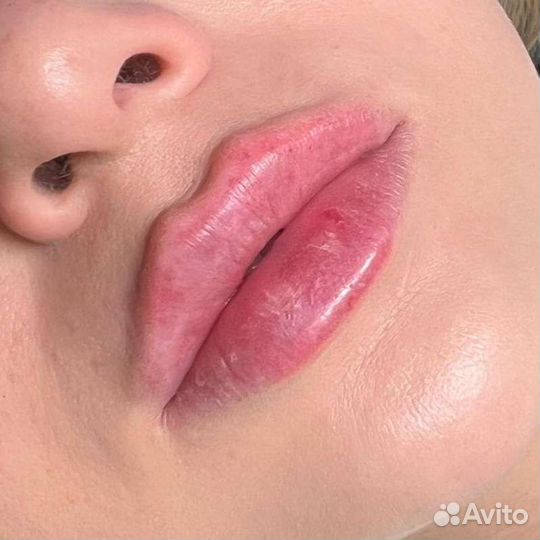 Увеличение губ