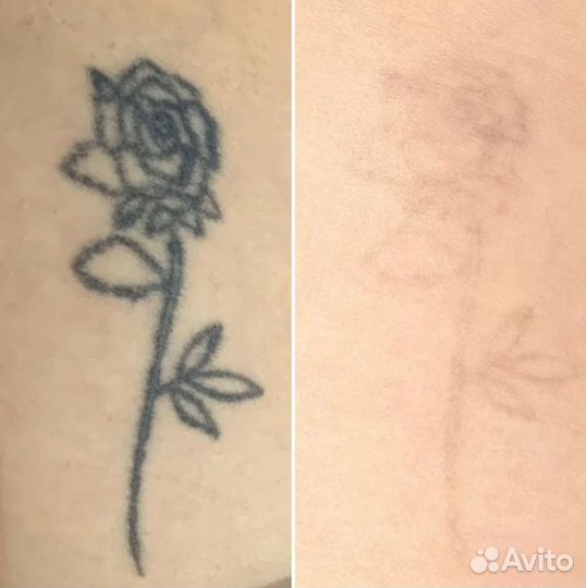 Лазерное удаление тату и татуажа