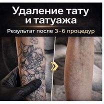 Лазерное удаление татуажа с онлайн записью, Москва