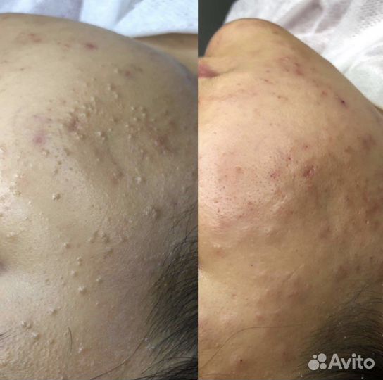 Чистка лица