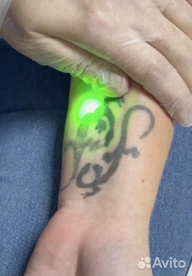 Удаление тату и татуажа. Карбоновый пилинг