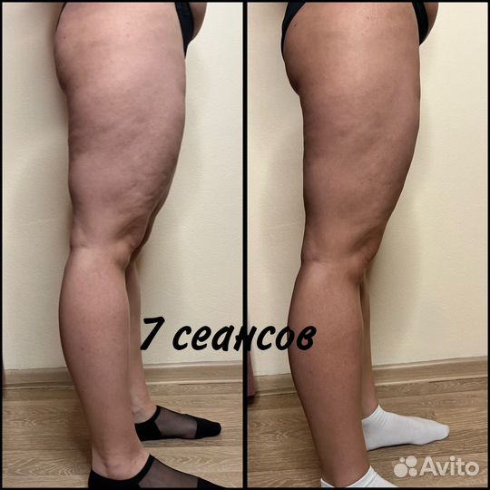 Антицеллюлитный массаж