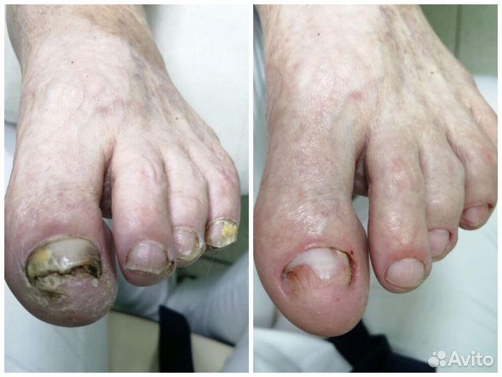 Снятие гель-лака с ногтей на ногах