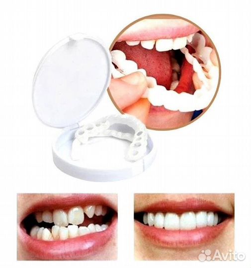 Виниры Snap-On TruSmile