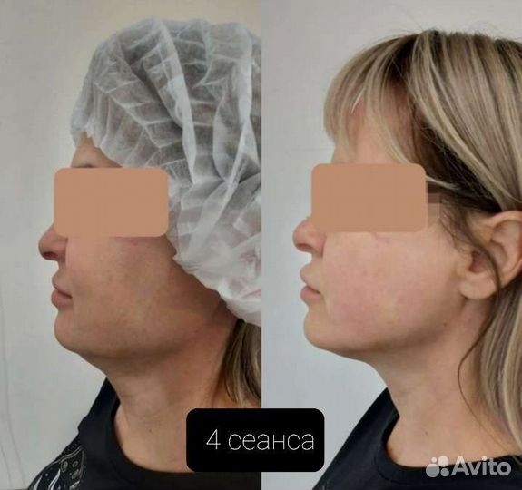 Похудение за 1 сеанс (аппаратная коррекция фигуры)