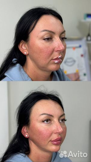 Подтяжка лица нитями