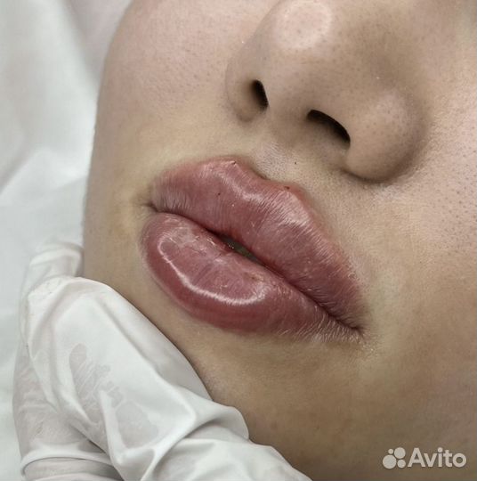 Увеличение губ
