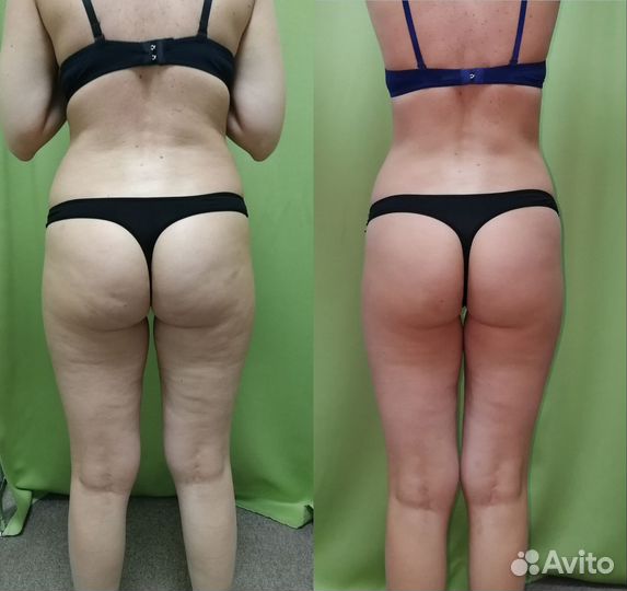 Экспресс похудение, минус 10кг реально. Массаж